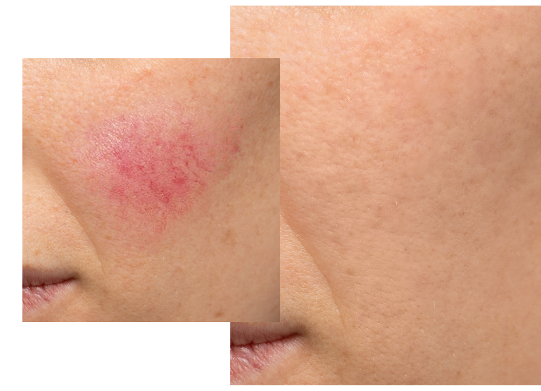 Bespoke Luxury Rosacea Treatment Beauty Affairs