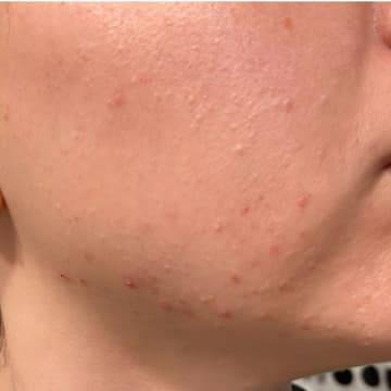 Close up of woman's face revealing troubling acne