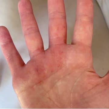 The palm of a woman's hand showing no signs of eczema after using goat milk soap