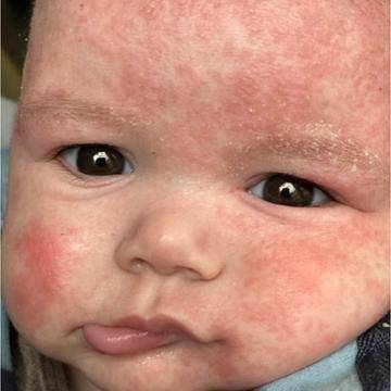 the skin on the face of an infant is covered in patches of eczema 