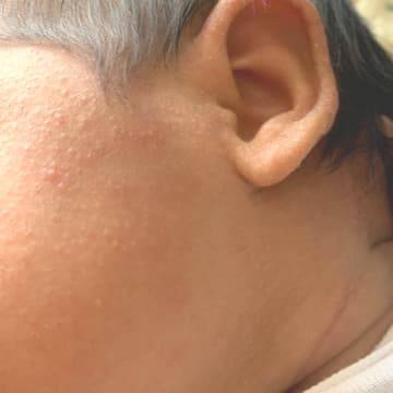 the cheek of a baby showing signs of visible infant acne