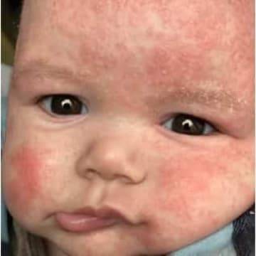 the skin on the face of an infant is covered in patches of eczema 