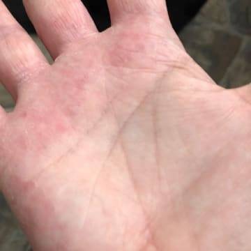 The skin on the palm of a woman's hand outstretched showing no severe signs of eczema