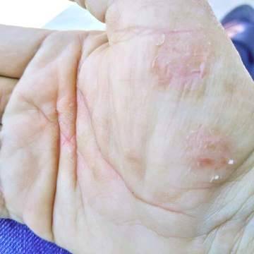 The palm of a woman's hand showing signs of dry skin and eczema