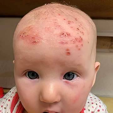 Young girl with severe signs of eczema on her scalp