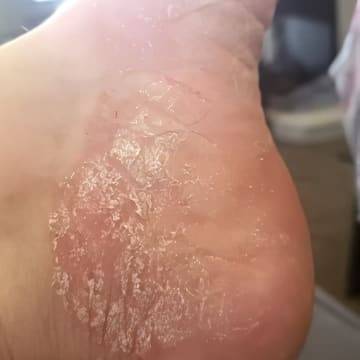 The skin on the heel of a woman's foot showing signs of dryness and eczema
