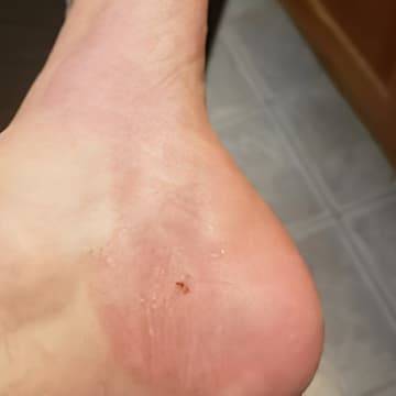 The skin on the heel of a woman's foot showing absolute healing 