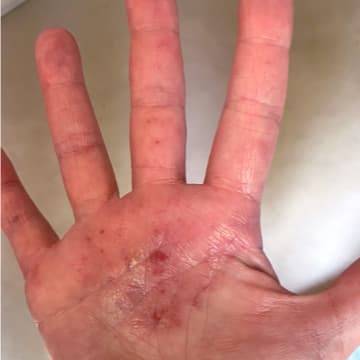 close up of the palm of a hand showing eczema patches