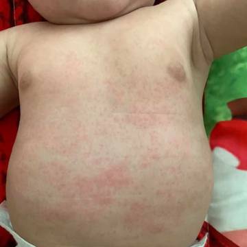 Baby's torso covered in eczema patches
