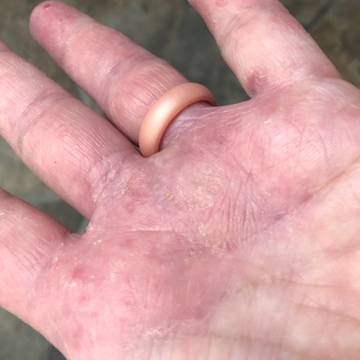 The palm of a woman's hand showing signs of dry skin and eczema