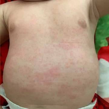 The skin on the stomach and chest of an infant showing signs of eczema