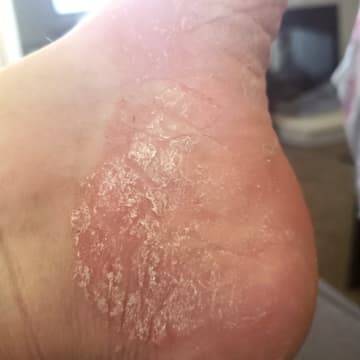 Close up of woman's heel with severe psoriasis
