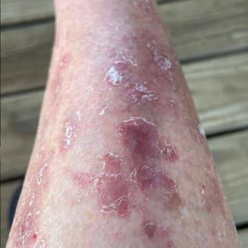 close up of a woman's leg with severe eczema