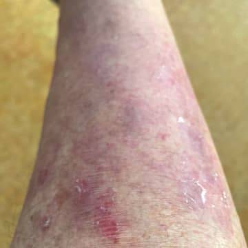 close up of a woman's leg showing decreased symptoms of eczema on the skin