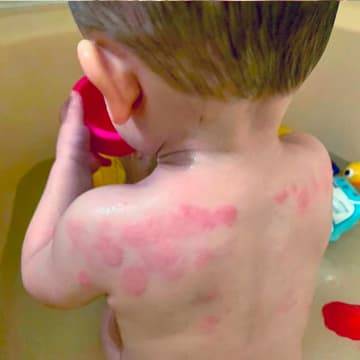 Young child in bath who's back is covered with signs of eczema